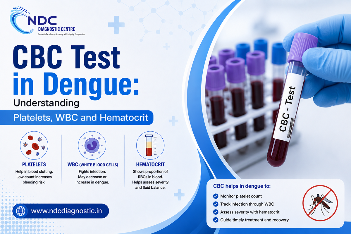 CBC Test in Dengue: Understanding Platelets, WBC and Hematocrit